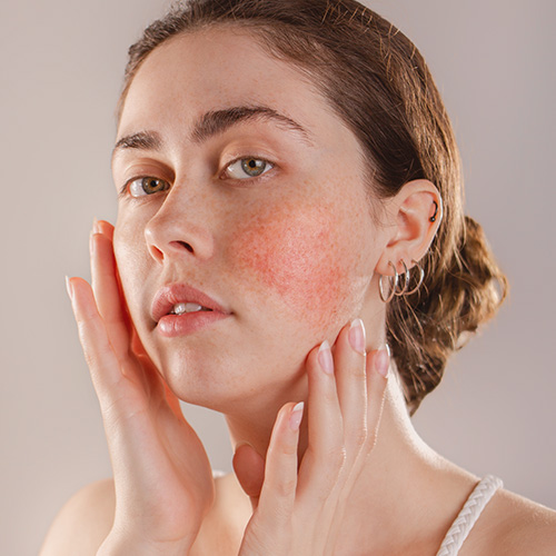 vein cta 1 woman with rosacea on her cheeks